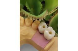 China Cemented Solution NOBEL BIOCARE Dental Implants Crown supplier