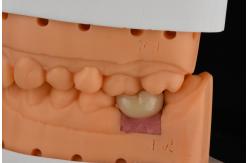 China Precision Cylindrical Silver Single Tooth Replacement Implants Dental Restoration supplier
