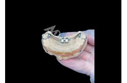 China MSE Palatal Expander Innovative Orthodontic Appliances For Effective Teeth Alignment supplier