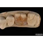Custom Compound Inlay Onlay For Minimally Invasive Dental Restoration for sale