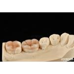 Natural Looking Composite Inlay Onlay Dental Restoration With Natural Appearance for sale