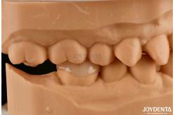 China polymerized porcelain Composite Inlay And Onlay Aesthetic And Durable Restorations supplier