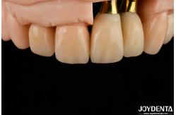 China Precision Dental Implant Crown and Bridge Perfect Solution for Aesthetically Pleasing Smile supplier