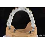 High Strength Ti-Base Hybrid Zirconia Bridge Fracture Resistance Dental Solution for sale
