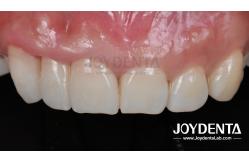 China Painless Procedure BOPT Dental Technique for Accurate Tooth Preparation supplier
