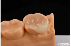 China polymerized porcelain Composite Inlay And Onlay Aesthetic And Durable Restorations supplier