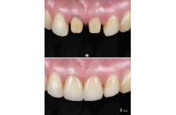 China Veneers Made With High Fracture Resistance Dental Zirconia And Multilayered Gradient Technology supplier