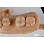 High Strength Zirconia Dental Inlays And Onlays For Tooth Restoration for sale