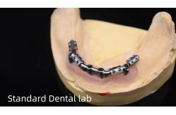 China Titanium Implant Supported Dentures Precise Ivoclar Denture Over Implants supplier