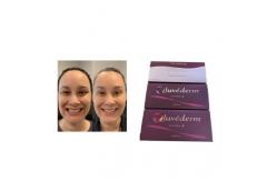 China Injection Juvederm Voluma Cross Linked Dermal Filler supplier