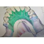 Removable 3D Printed Partial Denture Metal Framework
