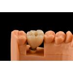 10mm Titanium Tooth Implant Sandblasted Self Tapping Dental Implants for sale