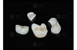 China Translucent Onlay Zirconia Inlay For Long Lasting Stain And Wear Resistance supplier