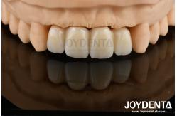 China Biologically Oriented Preparation Technique BOPT For Accurate Dental Preparation supplier