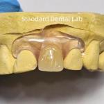 Dental TCS Valplast Flexible Partial Dentures Staining Fading Odors Resistant for sale