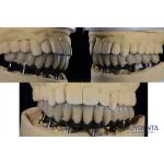 Titanium Multiple Teeth Dental Implant Prosthetic Surgery External Hexagon Connection for sale
