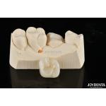 Zirconia Inlays And Onlays Tailor Made Restorations For Unparalleled Fit And Esthetics for sale