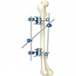 Excellent Quality Instrument Orthopedic Tibia & Percone External Fixator Orthopedic Surgical Instruments for sale