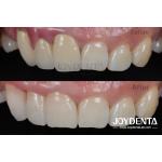 Painless Procedure BOPT Dental Technique for Accurate Tooth Preparation for sale