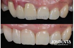 China Painless Procedure BOPT Dental Technique for Accurate Tooth Preparation supplier