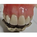 Esthetics Full Denture Cold Cured Acrylic Partial Denture for sale