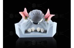China CE FDA Ball Attachment Dentures Comfortable Denture Ball Attachment Long Lasting supplier
