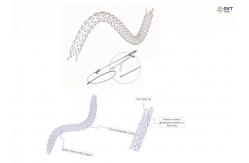 China Maximized Lumen URS Stent With Hydrophobic Nitinol Technology Anti Embedding Coating supplier
