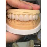 Customized Shades To Match Natural Teeth Biocompatible And Stain Resistant Dental Veneers for sale