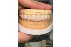 China Customized Shades To Match Natural Teeth Biocompatible And Stain Resistant Dental Veneers supplier