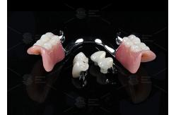 China Adjustable Multi Functional ERA Precision Attachment Removable ERA Attachments For Dentures supplier