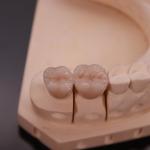 Comfortable Zirconia Crown with Precise Esthetic Finish Express 3-4 Day Turnaround Time for sale