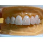 Lightweight and Smooth Dental Veneers Stain Resistance Long-lasting Durability for Optimal Comfort for sale