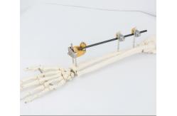 China T Shaped Clamp External Fixator For Distal Radius Fracture OEM supplier