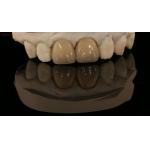 Full Contour Zirconia Crown and High Aesthetic Natural Dental Bridge 5 Year Guarantee for sale