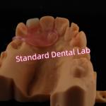 Upper Valplast Unilateral Dentures Removable Flexible One Tooth Partial Teeth for sale