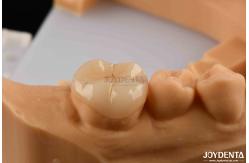 China polymerized porcelain Composite Inlay And Onlay Aesthetic And Durable Restorations supplier