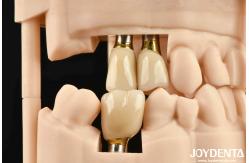 China High Durability White Finish Implant Crown And Bridge With Accurate Fit supplier