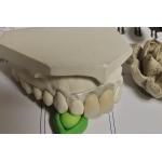 Temporary Soft And Elastic Valplast Invisible Denture for sale