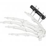 Orthopedic Surgical Mini Fragment Ilizarov External Fixation Device
