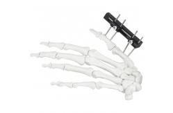 China Orthopedic Surgical Mini Fragment Ilizarov External Fixation Device supplier