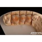 High Chipping Resistance And Natural-looking Esthetics With Multilayer Full Zirconia Technology
