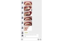 China Anterior Tooth Indication Dental Veneers With 0.5mm Thickness And Perfect Permeability supplier