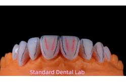 China Dental PFM Crown manufacturer