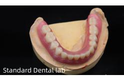 China Titanium Implant Supported Dentures Precise Ivoclar Denture Over Implants supplier