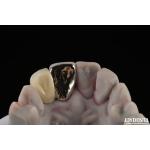 Metallic Dental Maryland Bridge Good Chewing Function For Long Lasting Remediation for sale