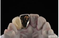 China Metallic Dental Maryland Bridge Good Chewing Function For Long Lasting Remediation supplier
