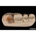 Custom Natural Looking Emax Dental Inlays And Onlays For Tooth Restoration for sale