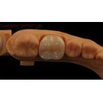 Dental Digital Full Zirconia Crown with Noritake Porcelain 3D Print Model 5 Year Guarantee for sale