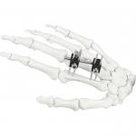 Orthopedic Surgical Mini Fragment Ilizarov External Fixation Device