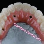Dental Implant Crown PFZ Porcelain Layered Zirconia Screw Retained With Pink Gum for sale